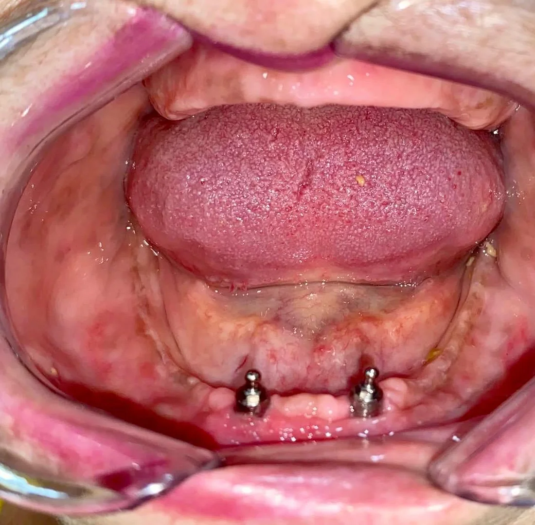 Implantes inferiores para retenção da overdenture