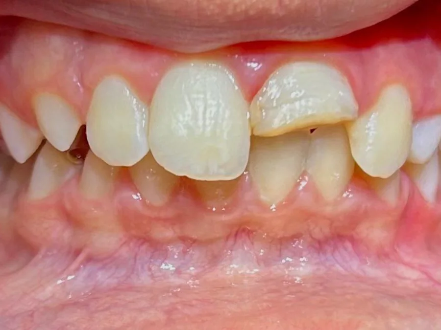Registro inicial de caso de reabilitação dos dentes anteriores
