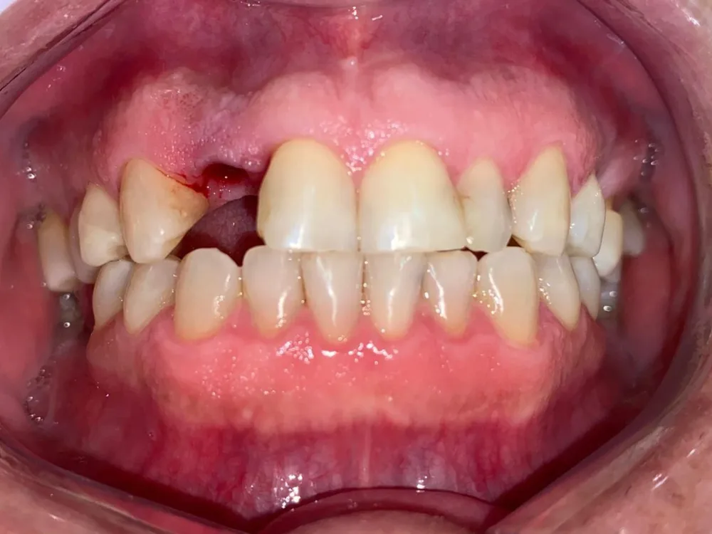 Registro inicial de caso de transformação funcional do sorriso
